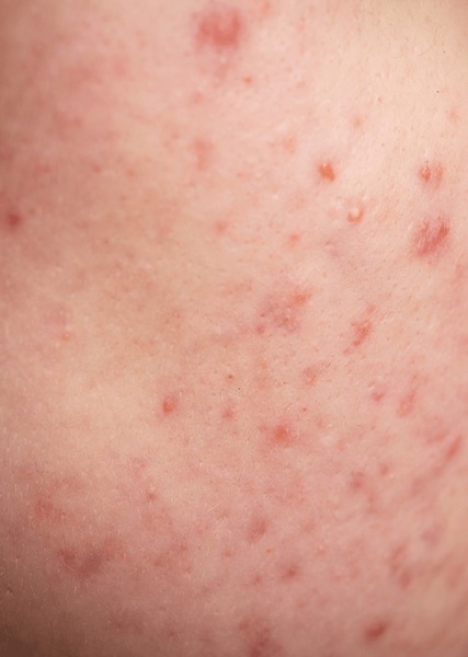 Skin texture and blemishes