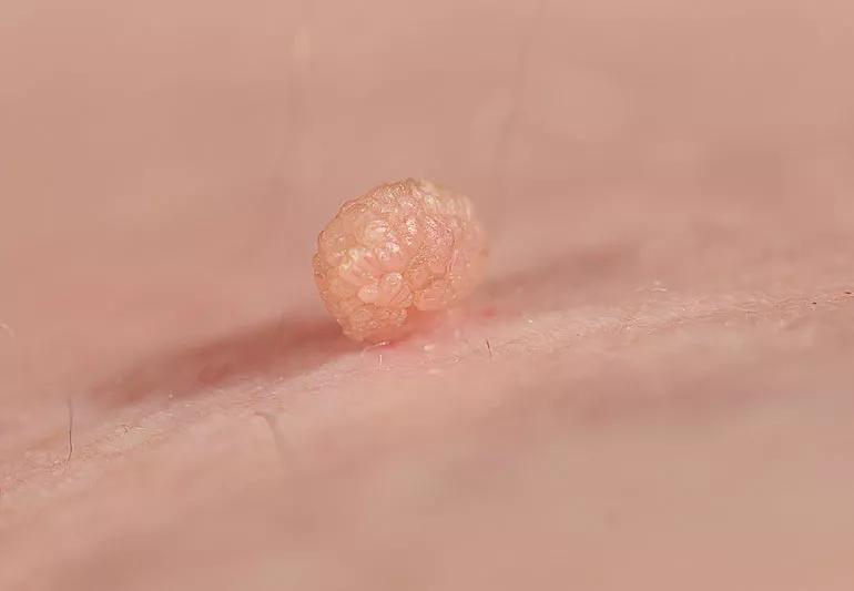 Close up of skin tag